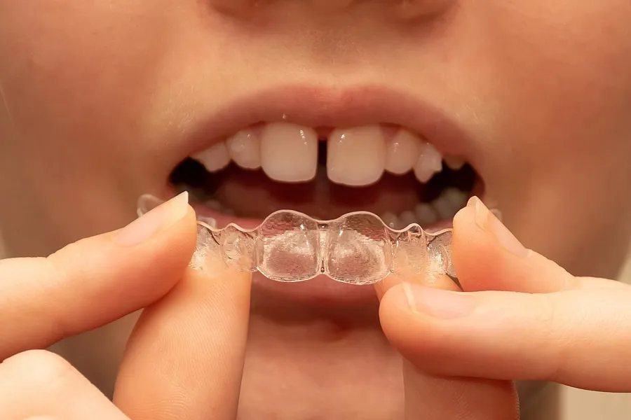 The Role of Orthodontic Consultations