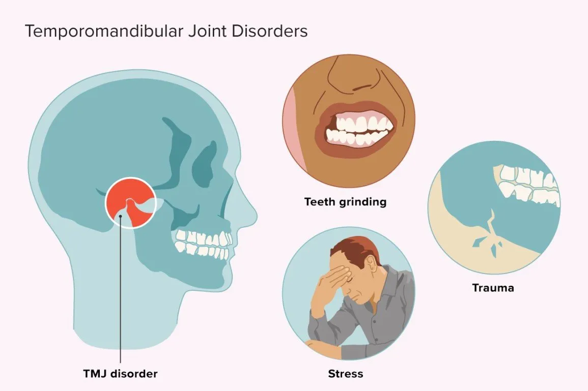 Understanding TMJ Disorders and Their Causes