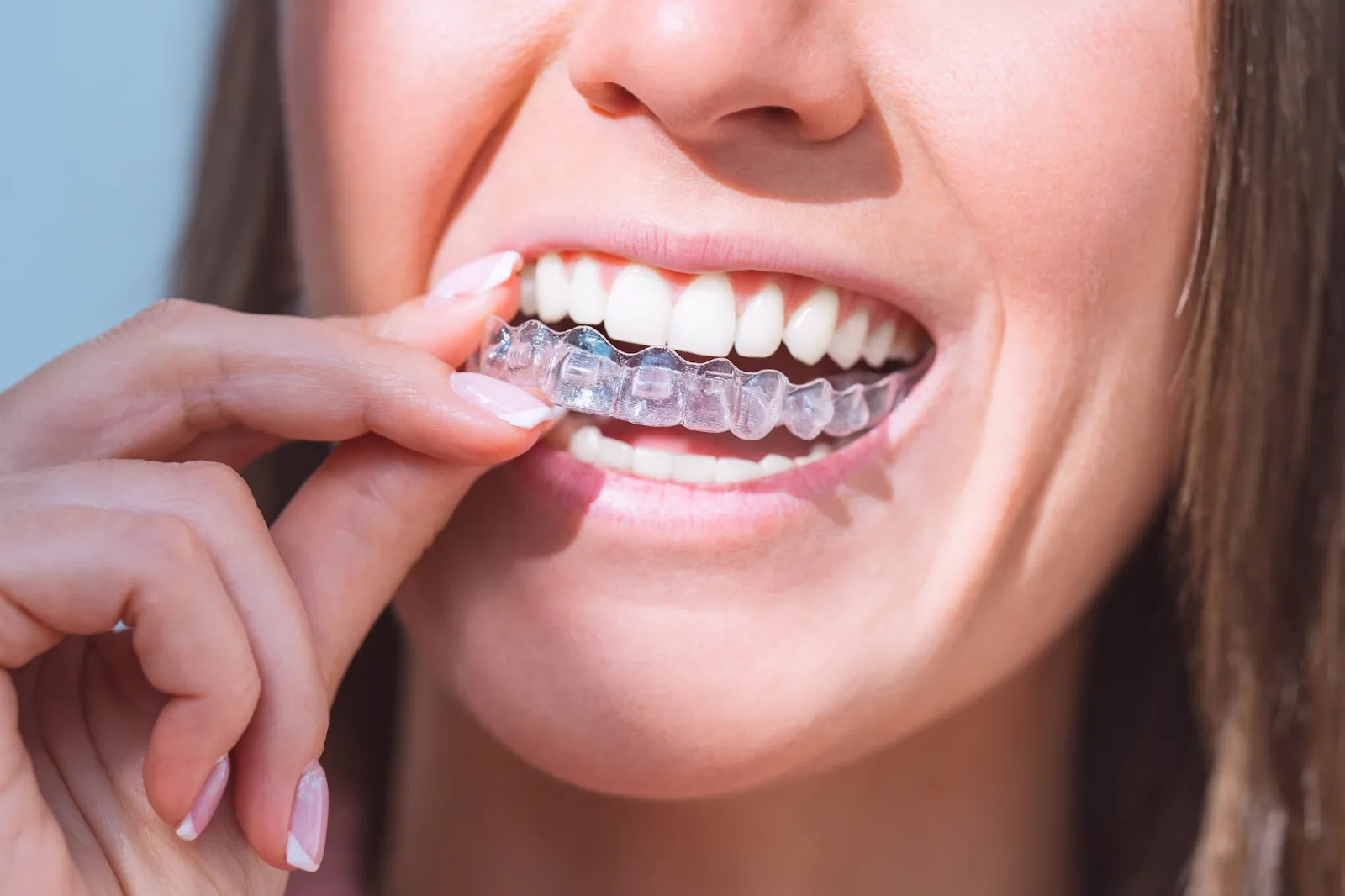 Exploring Invisalign as an Alternative
