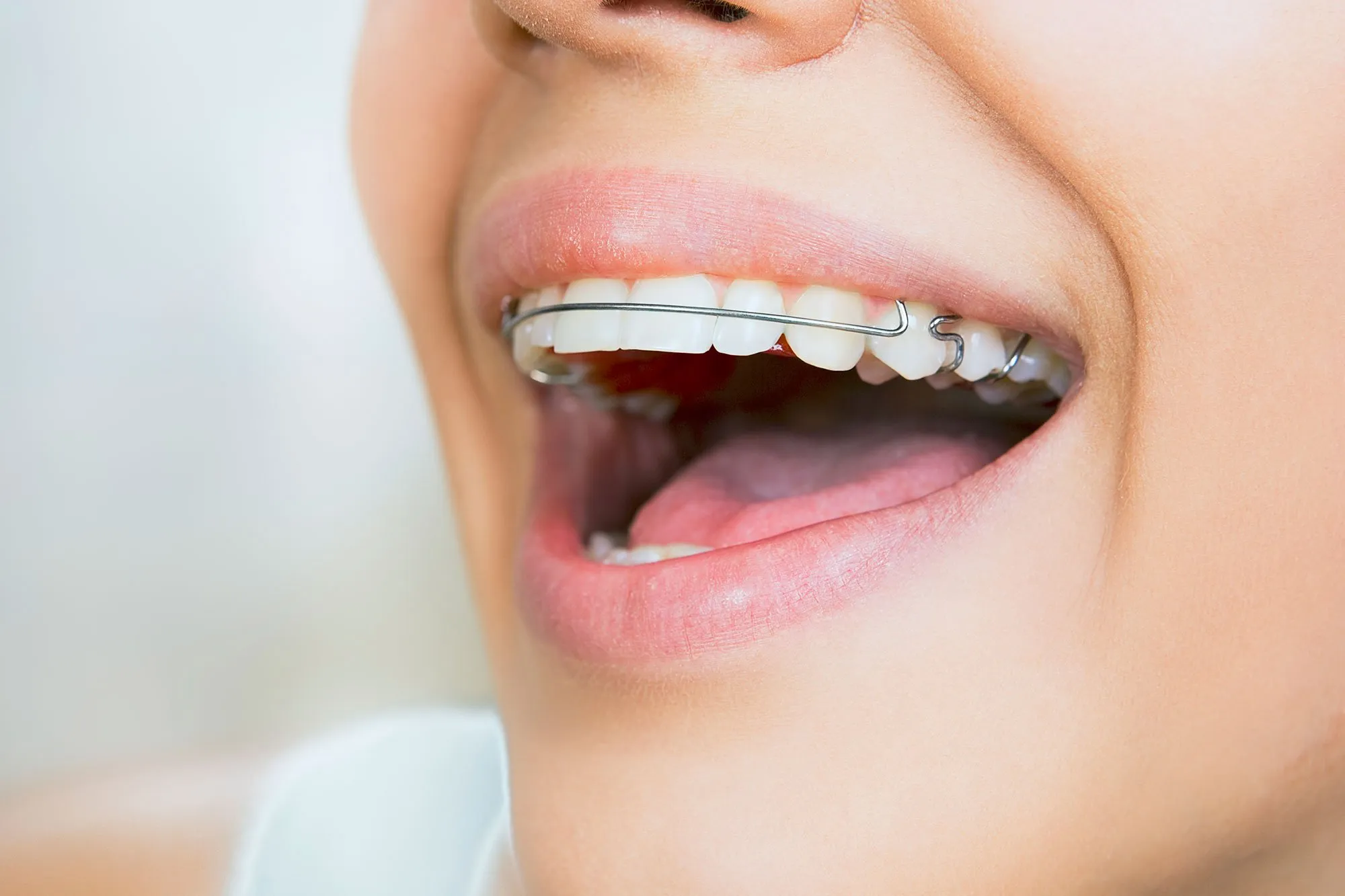 Benefits of Wearing Retainers