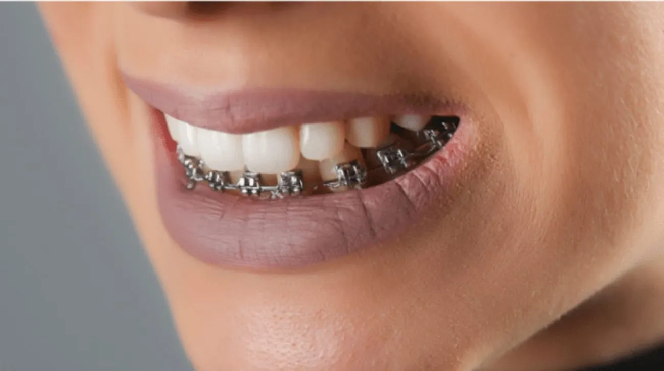 The Benefits of Placing Top Braces First