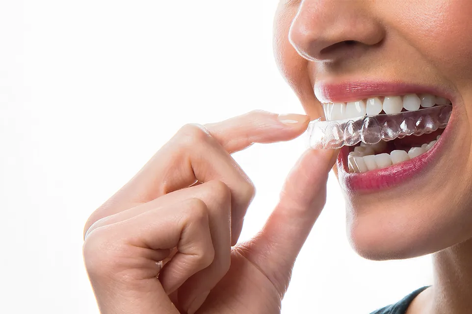 How Aligners Work