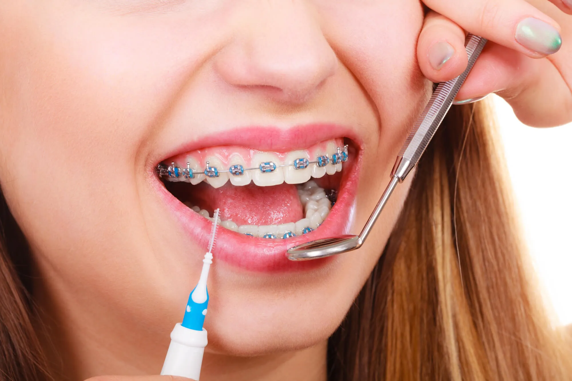 Understanding the Importance of Braces in Orthodontic Treatment