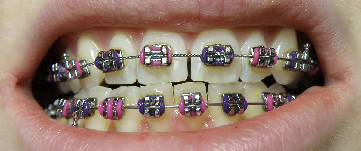 What Happens After Both Sets of Braces Are in Place?