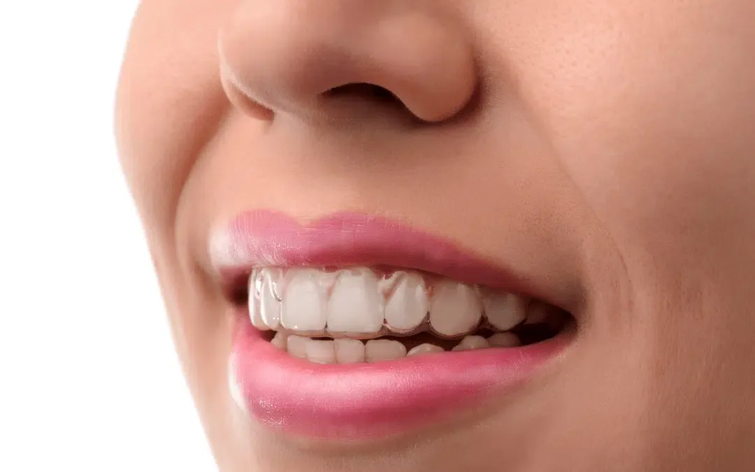 Customizing Invisalign Treatment for Fitness Enthusiasts