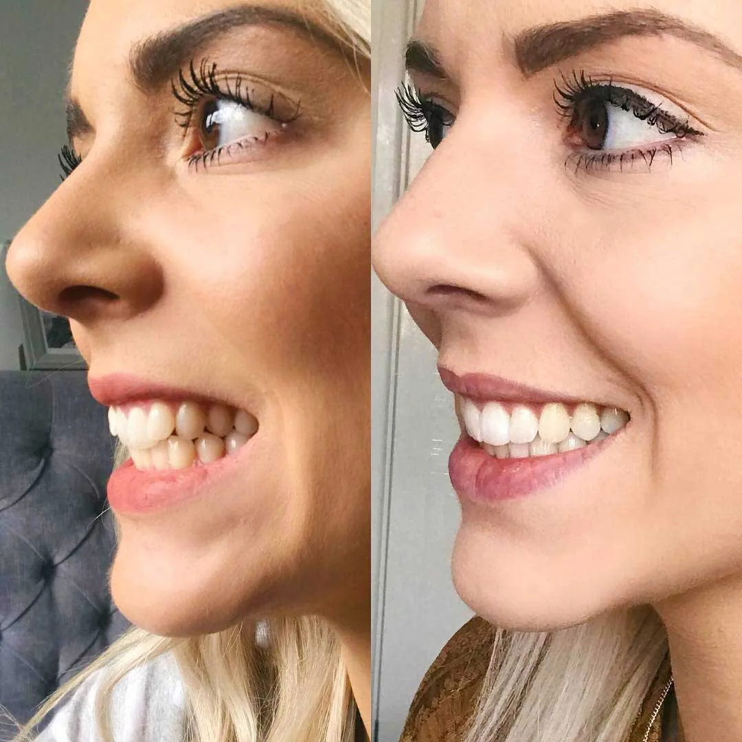 The Future is Clear(aligner)