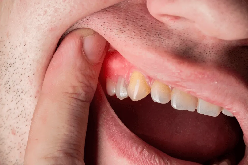 Can an Orthodontist Detect the Effects of Vaping?