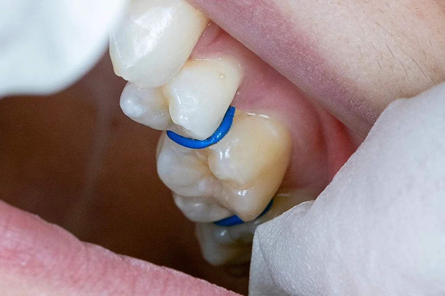 How Invisalign Works for People with Missing Teeth
