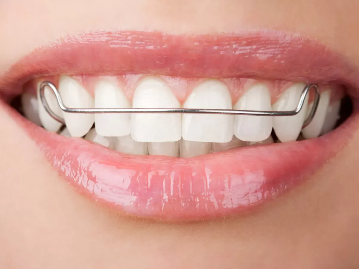 How Long Do Orthodontists Typically Keep Retainer Molds?