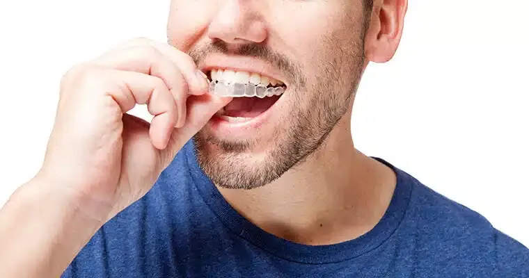 Tips for Maintaining Oral Health with Aligners
