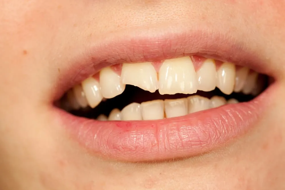 What Is Teeth Shaving After Braces?