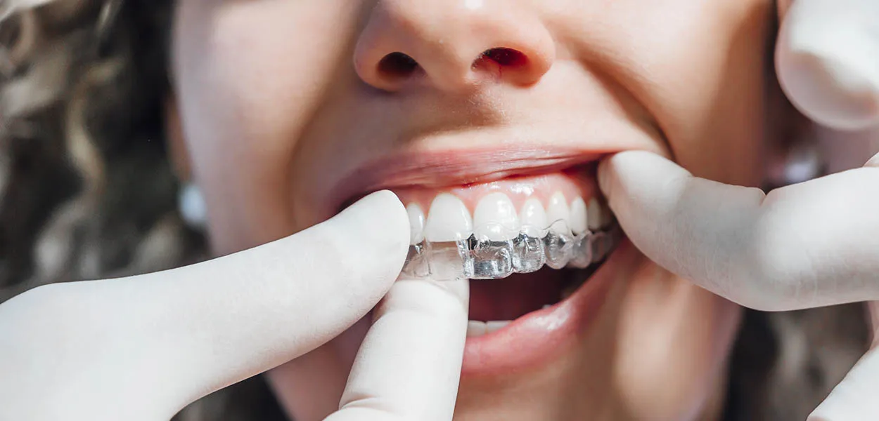 Factors Influencing the Number of Invisalign Trays