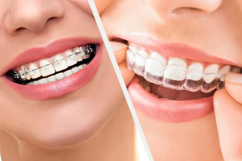 Clear Aligners: A Modern Alternative