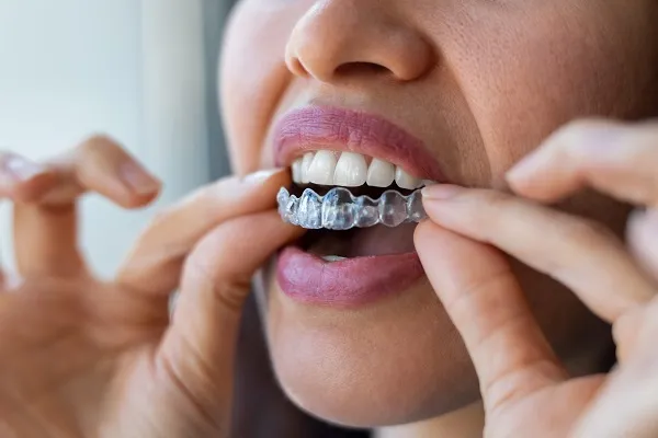 Final Thoughts on Your Invisalign Journey